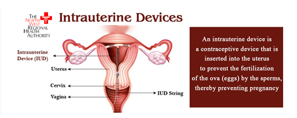 What is an Intra-Uterine Contraceptive Device?